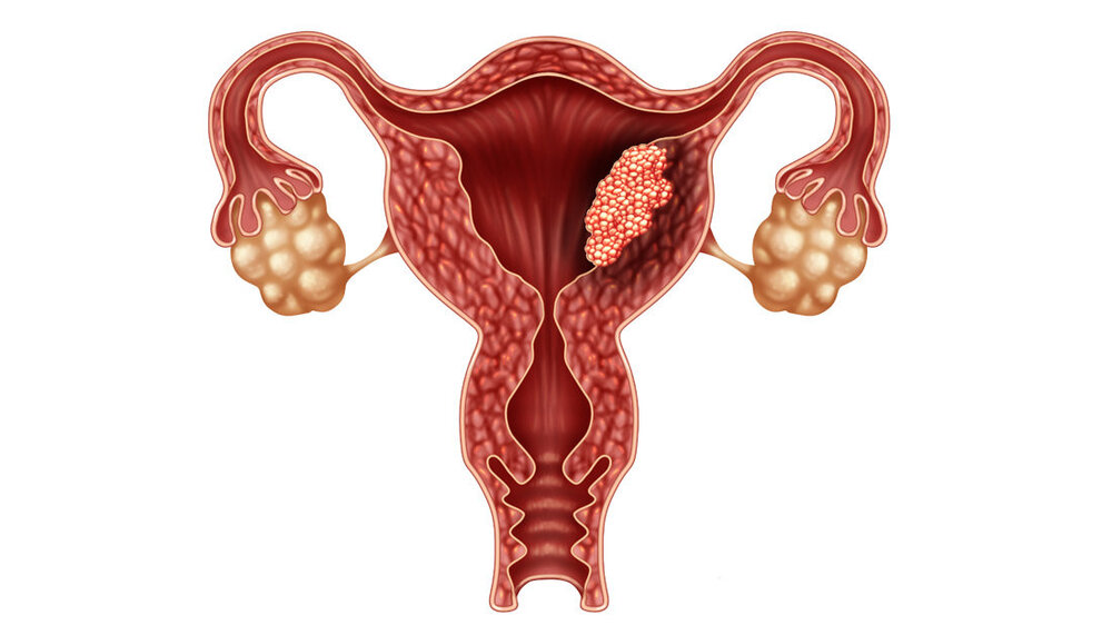 Endometriumkarzinom.jpg Schaubild für Endometriumkarzinom.