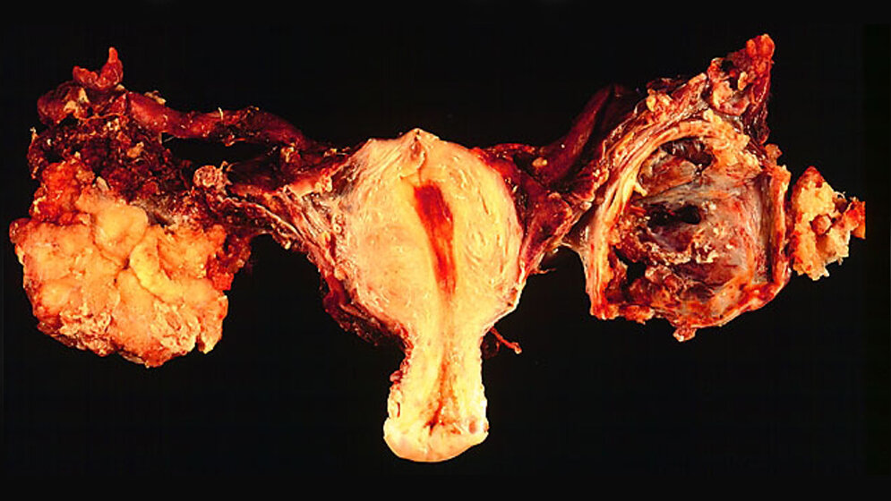 beidseitiges_Ovarialkarzinom_Ed_Uthman_MD_public_domain.jpg Beidseitiges Ovarialkarzinom