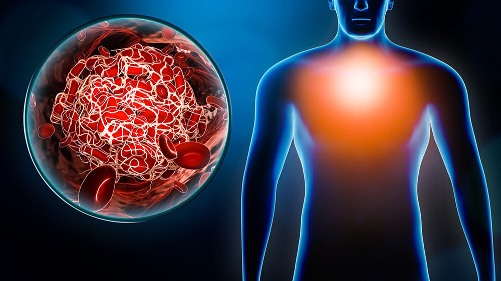 Lunge_Embolie.jpg Darstellung eines menschlichen Körpers mit hervorgehobenem Brustbereich und einer Nahaufnahme eines Blutgerinnsels, symbolisiert Herz-Kreislauf-Erkrankungen.