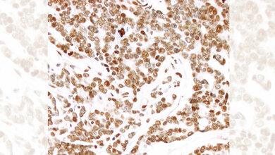 metastasiertes_und_schnell_wachsendes_Prostatakarzinom_Sven_Perner.jpg metastasiertes und schnell wachsendes Prostatakarzinom