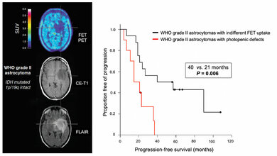 Patient_mit_niedriggradigem_hirneigenen_Tumor_Galldiks_et_al_Neuro_Oncol_2019.jpg Patient mit niedriggradigem hirneigenen Tumor