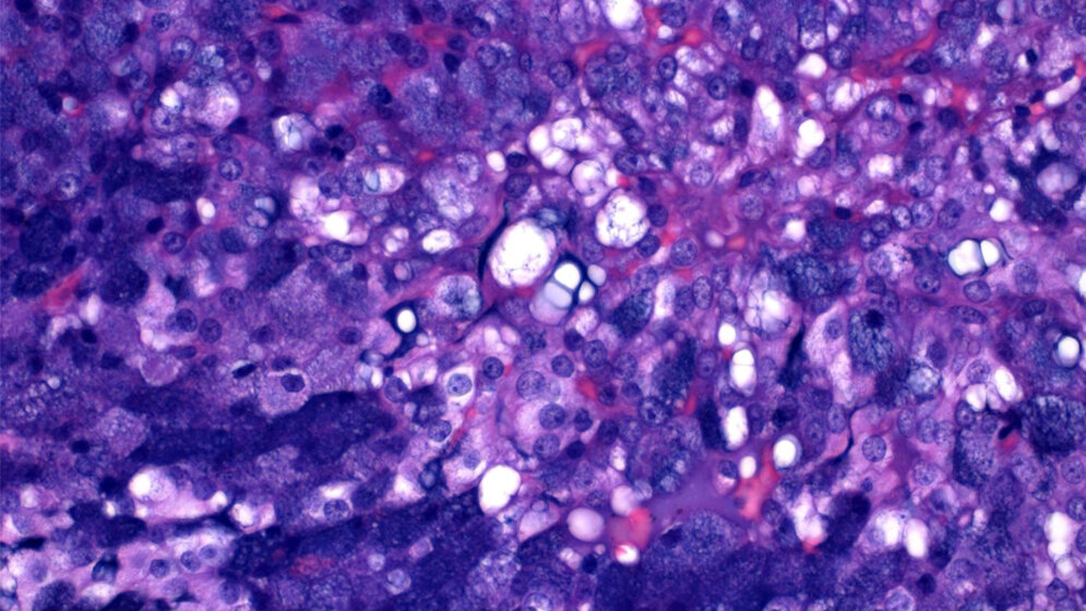 Mikroskopische_Aufnahme_eines_Azinuszellkarzinoms_der_Speicheldruese_Universitaetsklinikum_Erlangen_Abbas_Agaimy.jpg Azinuszellkarzinom der Speicheldrüse