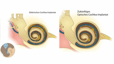 Herkoemmliches_Cochlea_Implantat_und_optogenetisches_Implantat_Institut_fuer_Auditorische_Neurowissenschaften_Unimedizin_Goettingen.jpg optogenetisches Implantat