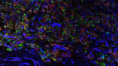 Melanom_Shani_Dror_Carmit_Levy_Tel_Aviv_University_24082016.jpg Tumor in situ