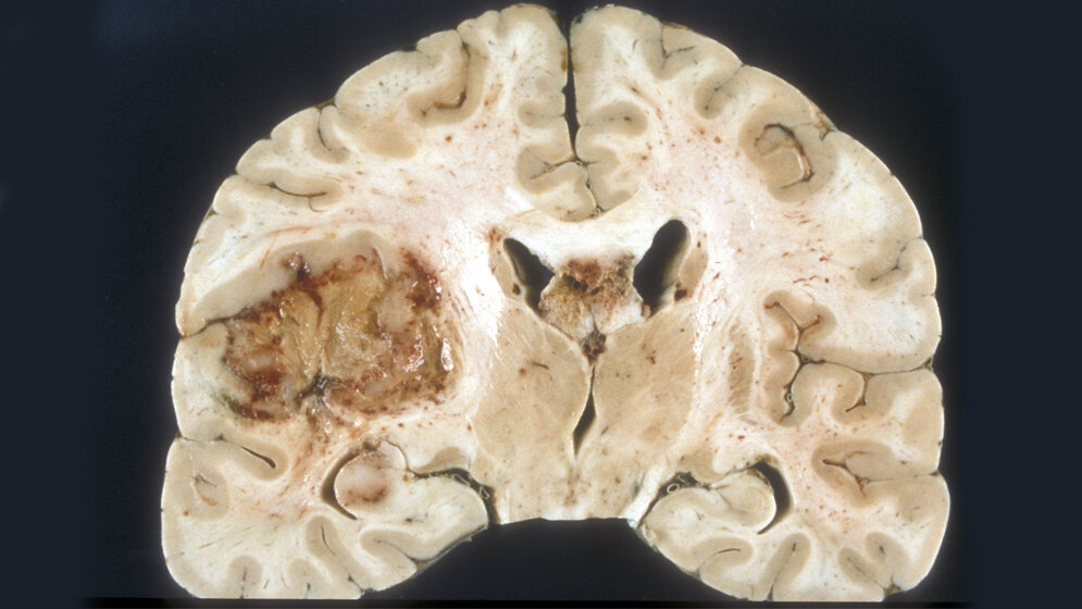 Glioblastom_Makroskopisches_Praeparat_Von_Sbrandner_Eigenes_Werk_GFDL_23062016.jpg Glioblastom