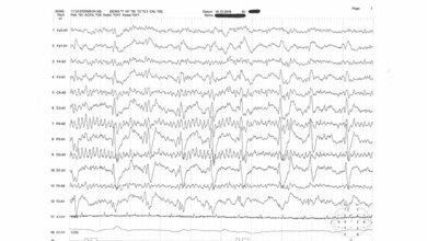 Neurologie Periodisch lateralisierte Komplexe (PLEDs) im EEG
