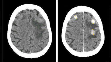 Hirnmetastasen_Von_Jmarchn_Eigenes_Werk_CC_BY_SA_3_0_30062016.jpg Multiple Metastasen