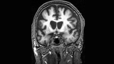 MR_Hirnscan_eines_Patienten_mit_Huntington_Frank_Gaillard_Own_work_CC_BYSA_3_0.jpg MR-Hirnscan eines Patienten mit Huntington