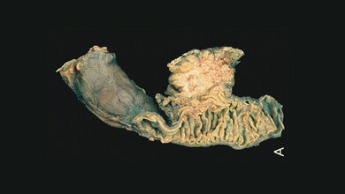 Operativ_entfernter_Tumor_Pankreas_mit_anhaengendem_Zwoelffingerdarm_The_Armed_Forces_Institute_of_Pathology_AFIP_Gemeinfrei.jpg Operativ entfernter Tumor