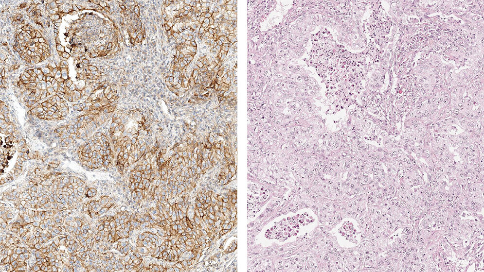 Laboratoriumsmedizin Optimierung und Validierung von PD-L1-Färbeprotokollen am Beispiel E1L3N (Teil 2)