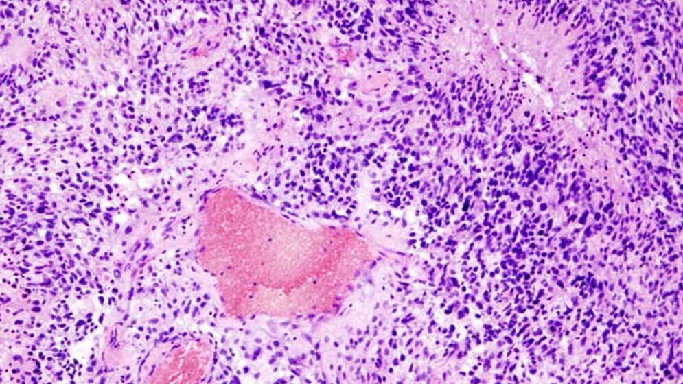 Glioblastom_histologisches_Praeparat_HE_Faerbung_Autor_KGH_CC_BY_SA_3_0.jpg Hirntumoren