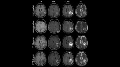 MRT_Aufnahmen_im_Verlauf_der_Erkrankung_bei_einem_Patienten_mit_Glioblastom_DKFZ.jpg Glioblastom
