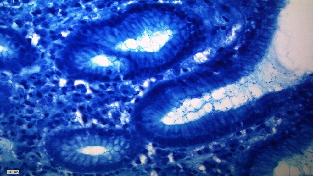 Helicobacter_pylori_Magenschleimhaut_modifizierte_Giemsa_Faerbung_Alexquaas_CC_BY_4_05022016.jpg Helicobacter-pylori-Infektion