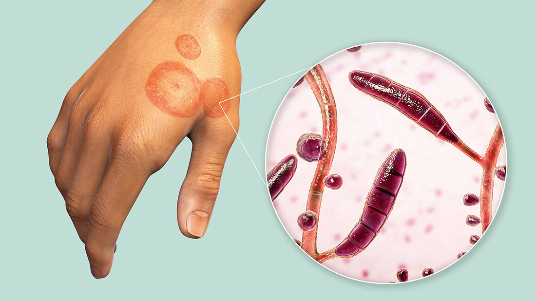 Dermatophyten und Dermatophytosen (Teil 2) Grafik einer infizierten Hand mit Vergrößerung der Dermatophyten