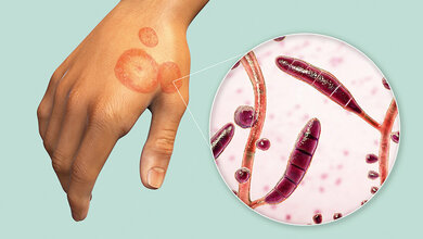 Dermatophyten und Dermatophytosen (Teil 2) Grafik einer infizierten Hand mit Vergrößerung der Dermatophyten