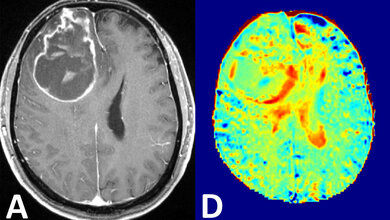 Glukose_MRT_Bildgebung_bei_7_Tesla_Paech_D_et_al_RSNA.jpg lukose-MRT Bildgebung