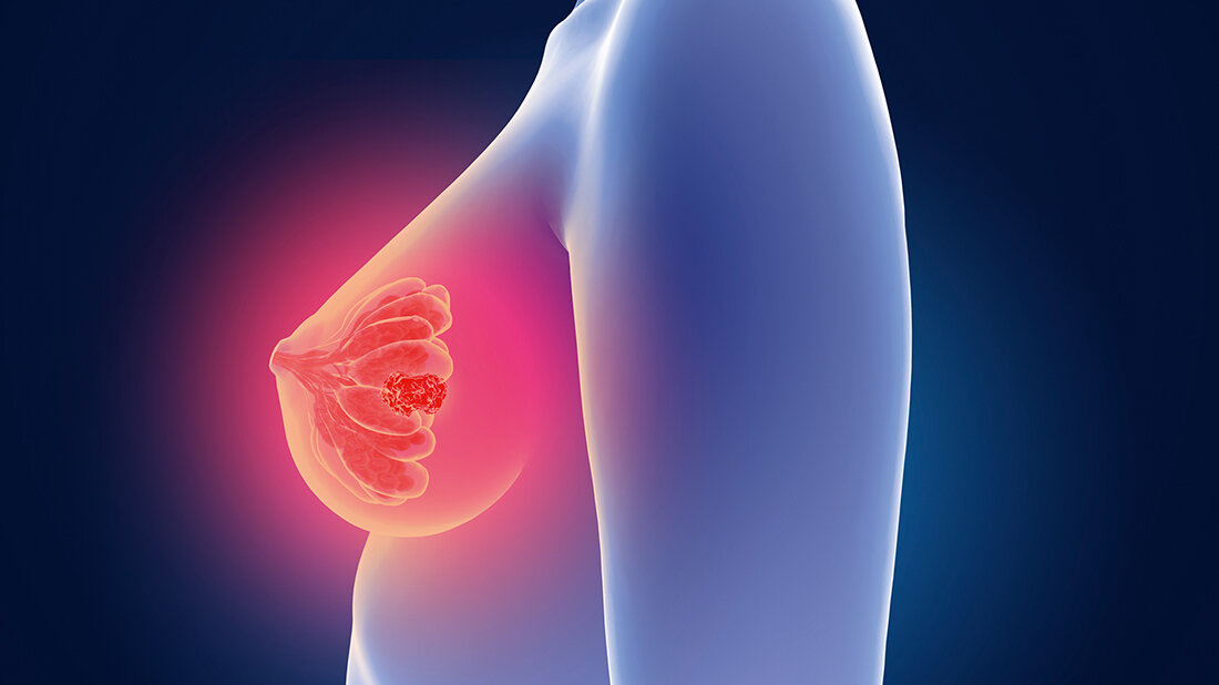 Seltene Strahlennebenwirkung BOOP Titelbild zum Fachbeitrag über die seltene Strahlennebenwirkung BOOP