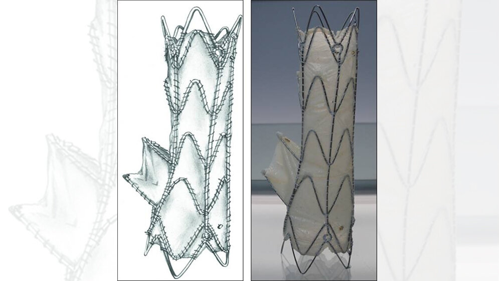 Ein_winziges_Roehrchen_mit_Ventil_uebernimmt_Funktion_der_schadhaften_Herzklappe_Universitaetsklinikum_Tuebingen.jpg Ein winziges Röhrchen mit Ventil