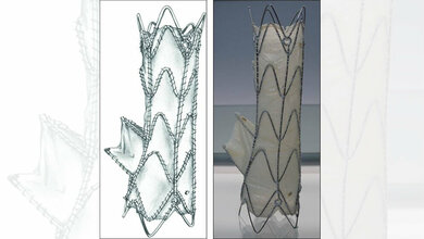 Ein_winziges_Roehrchen_mit_Ventil_uebernimmt_Funktion_der_schadhaften_Herzklappe_Universitaetsklinikum_Tuebingen.jpg Ein winziges Röhrchen mit Ventil