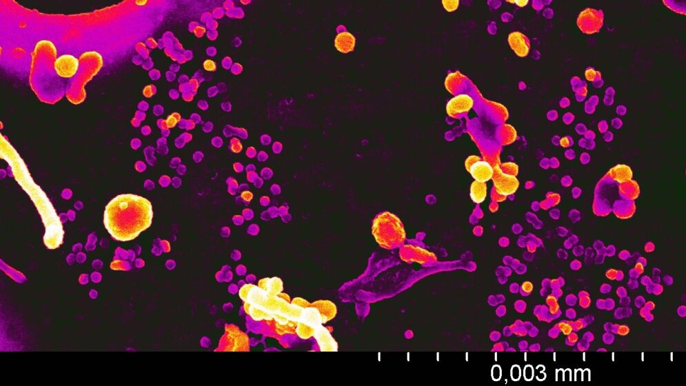 Freisetzung_HIV_Partikel_von_infizierten_menschlichen_Zellen_Dr_S_Kluge_Prof_P_Walther_01042016.jpg Freisetzung von HIV-Partikel von infizierten menschlichen Zellen