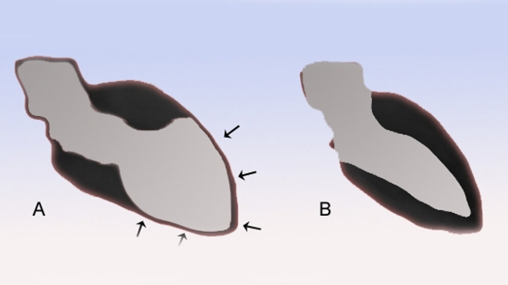 tako_tsubo_cardiopathie_By_J_Heuser_Own_work_CC_BY_SA_3_via_Wikimedia_Commons_31032016.jpg Tako-Tsubo Kardiomyopathie (A) und Normalperson (B)