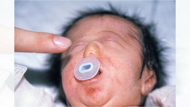 Partielle_Arhinie_Akkuzu_G_et_al_Congenital_partial_arhinia_a_case_report_J_Med_Case_Reports_1_97_2007_CC_BY_2_0.jpg Patient mit partieller Arhinie