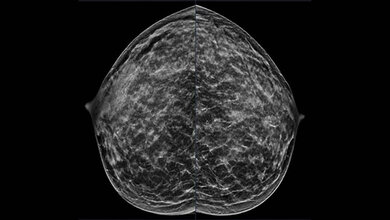 Mammo_RSNA.jpg Mammografie einer 40-jährigen Patientin.