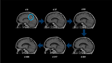 Beispielhafte_Rueckbildung_Glioblastomrezidivs_unter_CUSP9v3_in_der__MRT_Tim_Heiland_Klinik_fuer_Neurochirurgie_Uniklinikum_Ulm.jpg Beispielhafte Rückbildung eines Glioblastomrezidivs