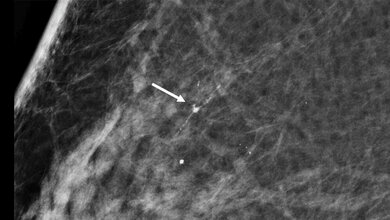 Digitale_Screening_Mammographie_mit_feinen_Verkalkungen_UKM.jpg Digitale Screening-Mammographie