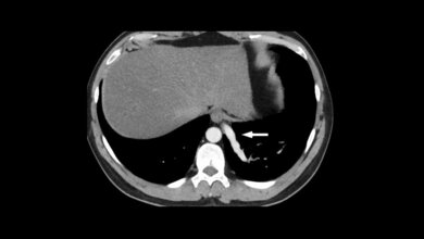 Anomalien und Normvarianten – Interne Veränderungen 2.23: interne vaskuläre Malformationen Titelbild des Fachbeitrags zur Bildgebung bei internen vaskulären Malformationen
