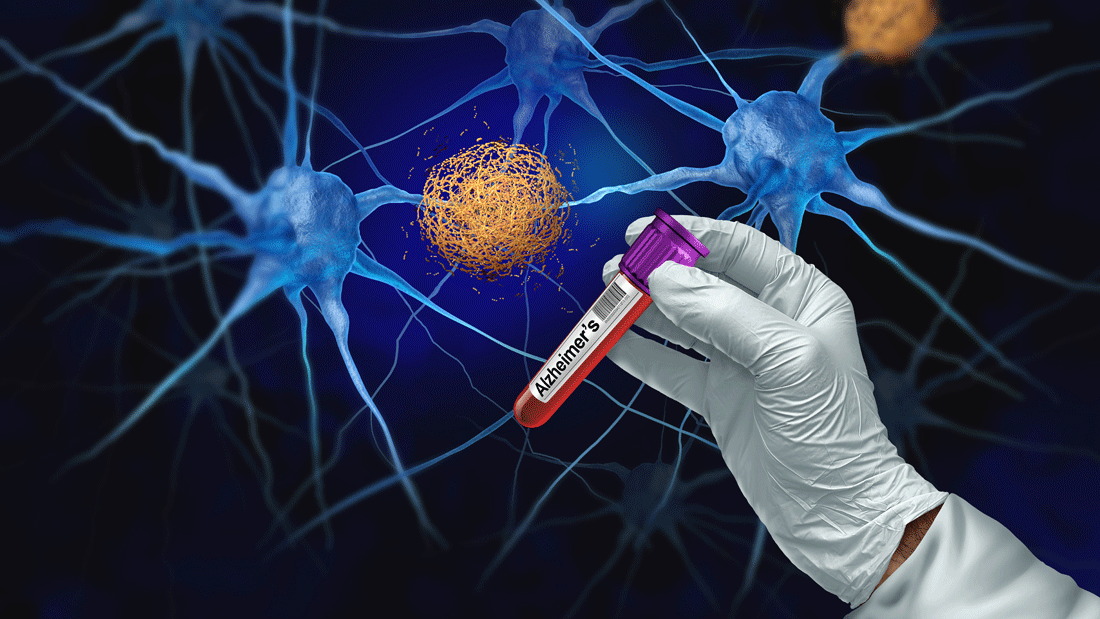 AdobeStock_1988959509.gif Behandschuhte Hand hält ein Blutröhrchen mit der Aufschrift „Alzheimer’s“ vor einer Darstellung von Nervenzellen und Plaques