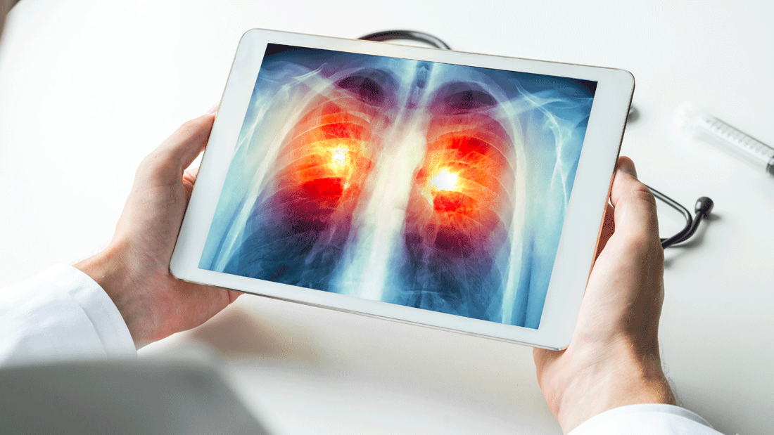 AdobeStock_221990236.gif Eine Person im weißen Kittel hält ein Tablet mit einer Röntgenaufnahme des Brustkorbs. Beide Lungen sind rot hervorgehoben; daneben liegen Stethoskop und Spritze.