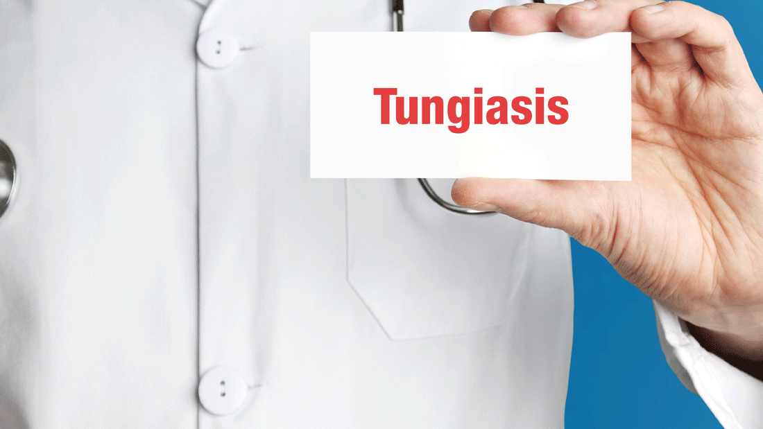 AdobeStock_341233347.gif Person im weißen Arztkittel mit Stethoskop hält eine Karte mit dem Wort „Tungiasis“ vor blauem Hintergrund.