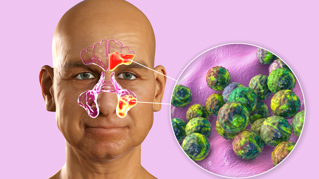 AdobeStock_424154853.gif Das Bild zeigt eine medizinische Darstellung, die auf eine Infektion oder Erkrankung hinweist. Der Fokus liegt auf einer Vergrößerung von Bakterien oder Zellen, die möglicherweise eine Krankheit oder Infektion symbolisieren.