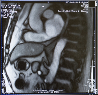 Standbild_Echtzeit_MRT_Speiseroehre_und_Uebergang_Magen_UMG_01032016.jpg Standbild aus dem Echtzeit-MRT