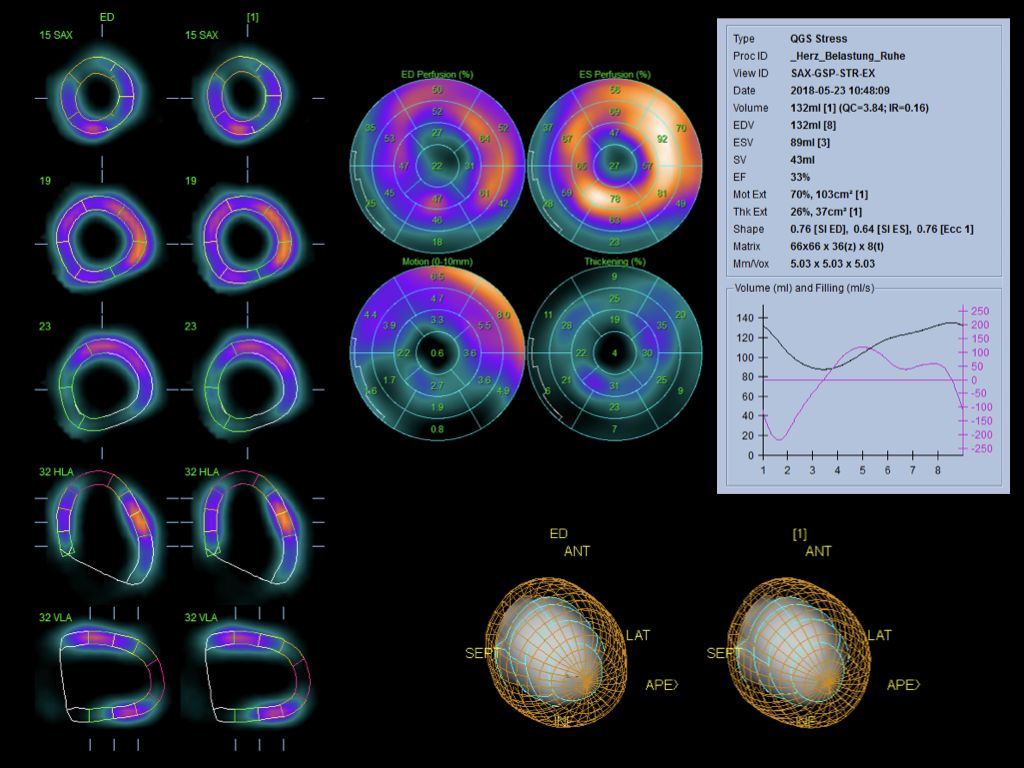 Mit_dem_neuen_Herz_SPECT_koennen_Aerzte_die_Durchblutung_des_Herzens_sehr_gut_untersuchen_Uniklinikum_Freiburg.jpg Herz-SPECT