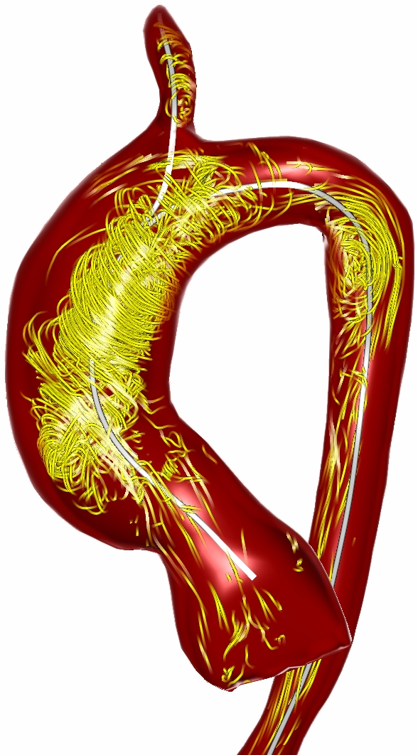 Verwirbelungen_Blutfluss_als_Folge_der_pathologisch_geweiteten_Aorta_Quelle_Monique_Meuschke_Arbeitsgruppe_Visualisierung_02052016.jpg Verwirbelungen des Blutflusses