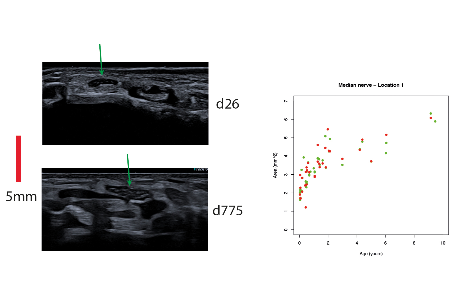 DGKN.jpg Korrelation zwischen Alter und Durchmesser des Nervus medianus